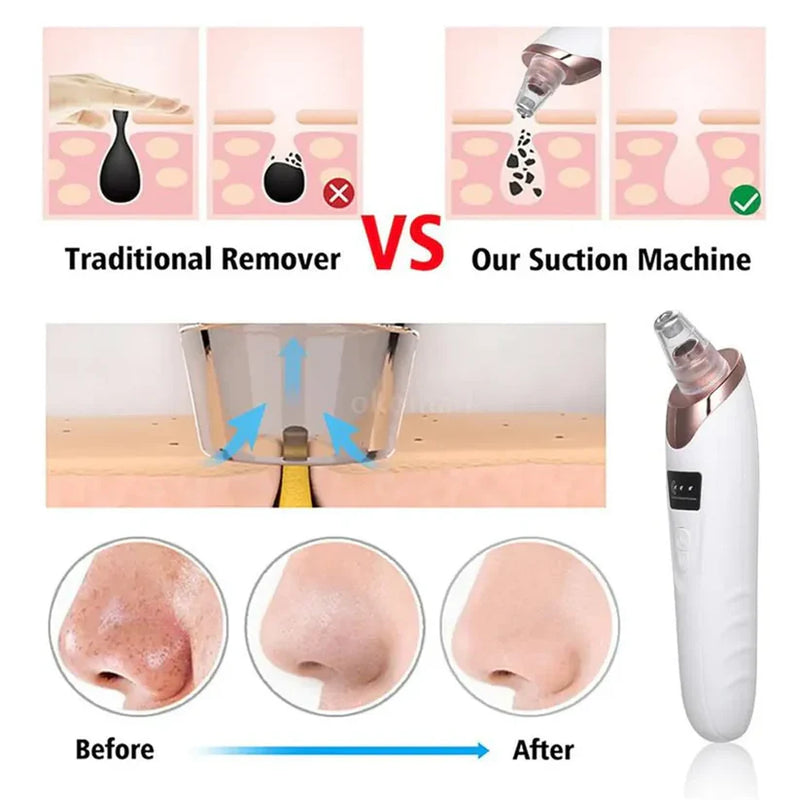 Rechargeable 5 in 1 Multifunctional Black Head Removal Machine
